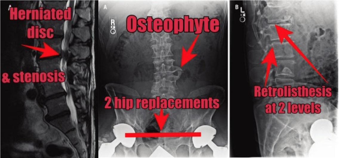 Physical therapy and back pain MRI… what can we do? Dr. Abbate