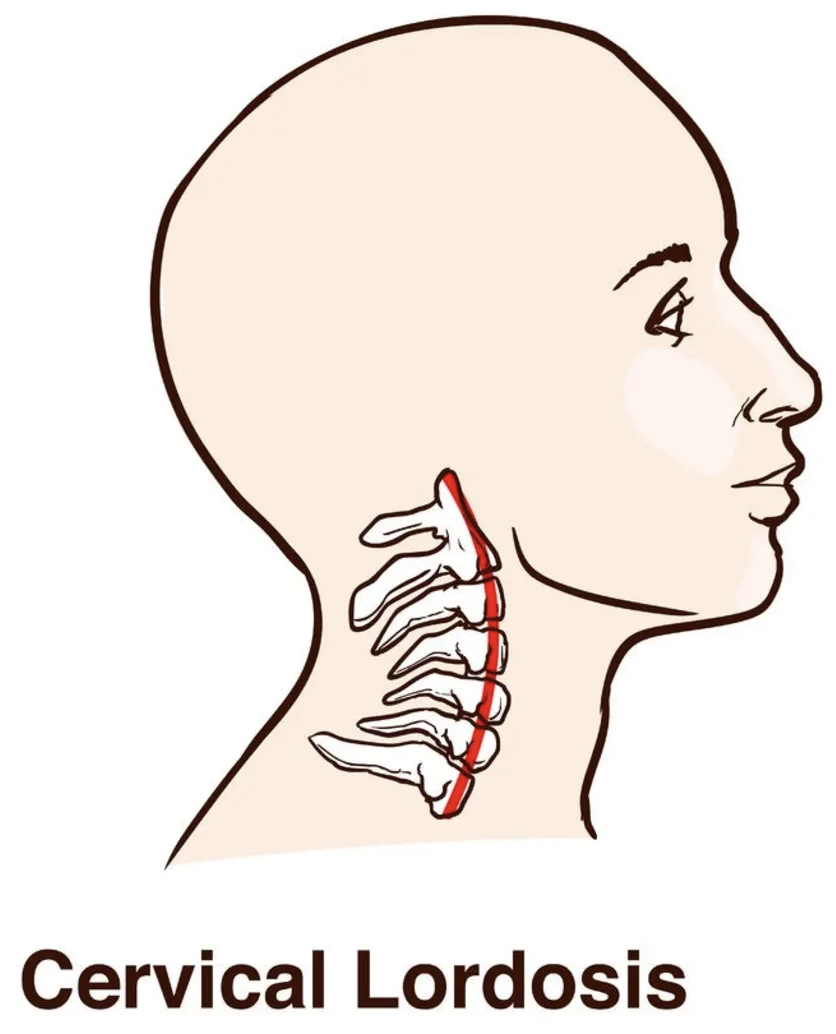 Cervicogenic Headache And Posture Dr Abbate Physical Therapy 6556